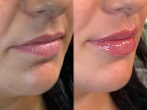 Lip Flip