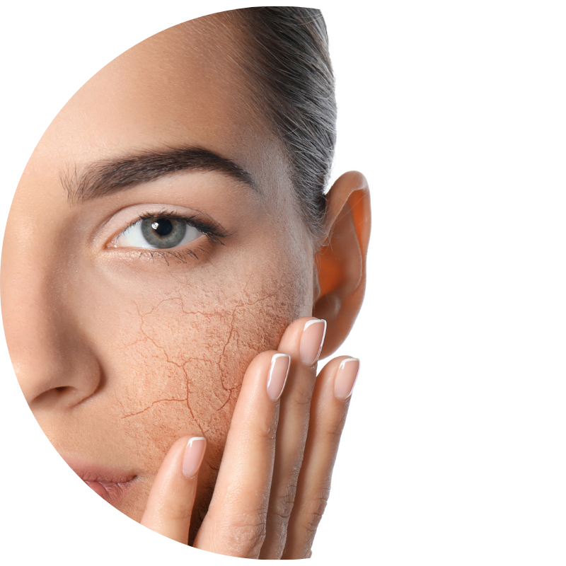lady touching her dehydrated skin on her face